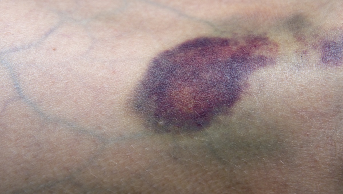 Bruised leg showing veins. Main focus is on bruise at center of image.